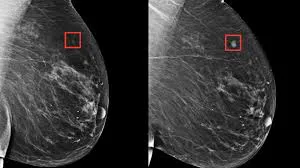 Cáncer de mama -Salud -IA