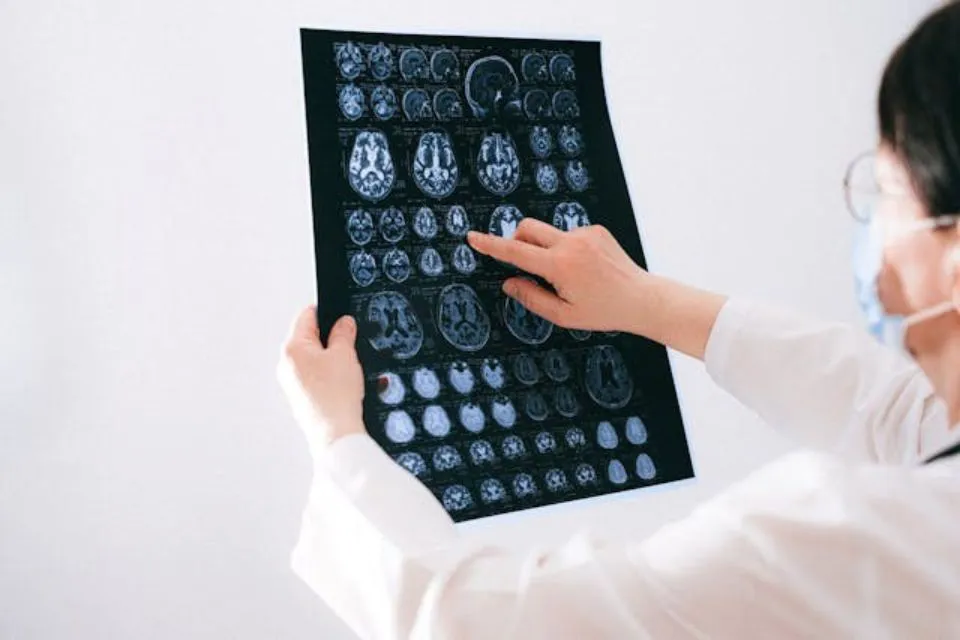 Placas Alzheimer