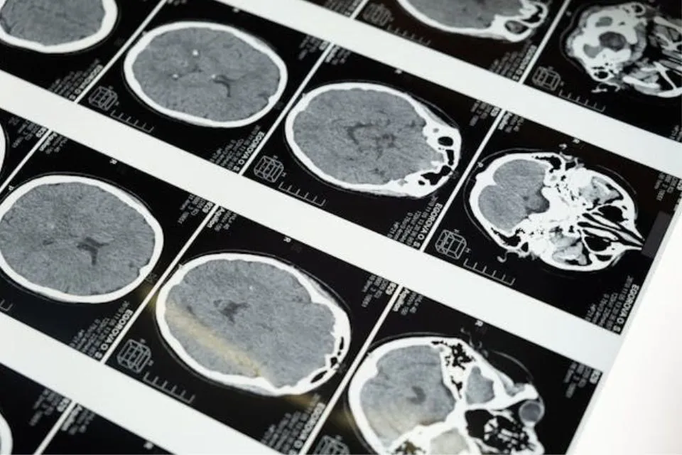 cerebro