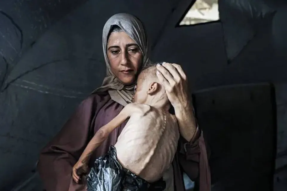 Un niño de un año y medio que padece desnutrición aguda debido al bloqueo israelí en Gaza|Foto: BBC Mundo/Getty Images Más de 100 agencias de ayuda humanitaria advierten que la "hambruna masiva" se extiende en Gaza


