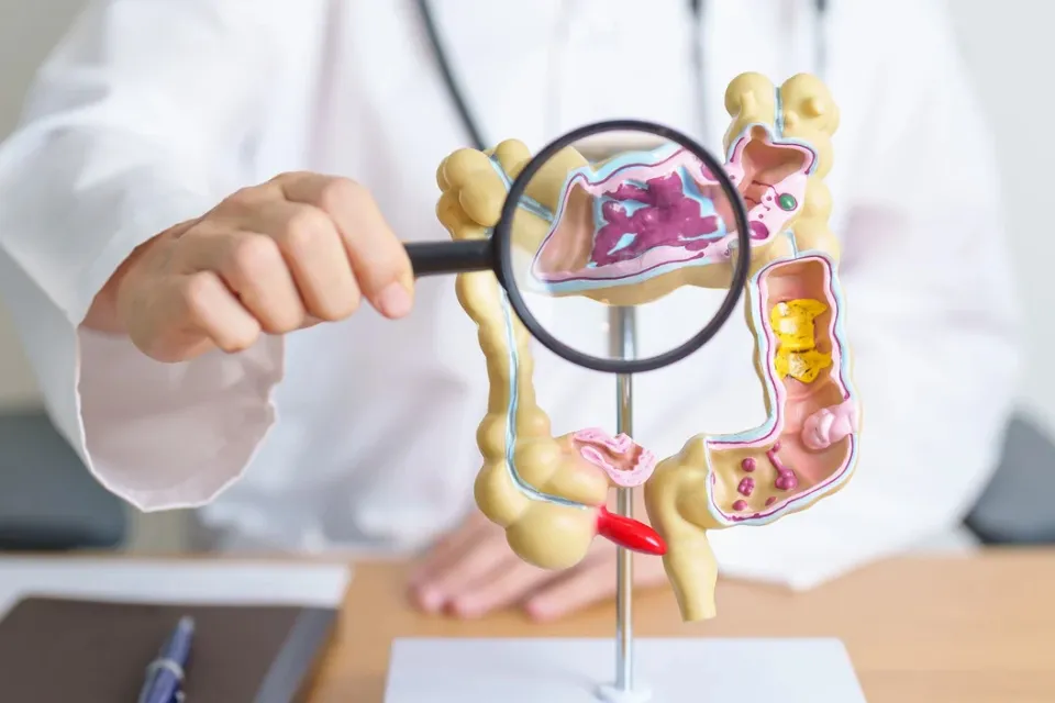  Cáncer colorrectal en jóvenes Una infección en la infancia se relaciona con el aumento del cáncer colorrectal en jóvenes, según un estudio 