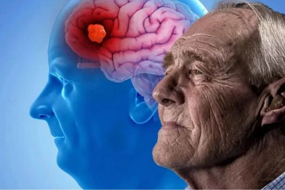 _Alzheimer