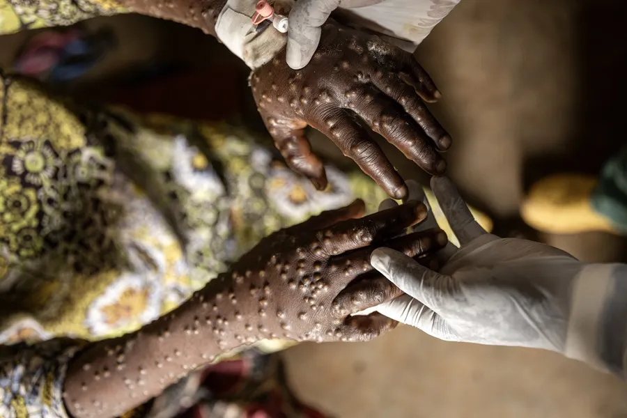 mpox-africa | Foto: EFE.