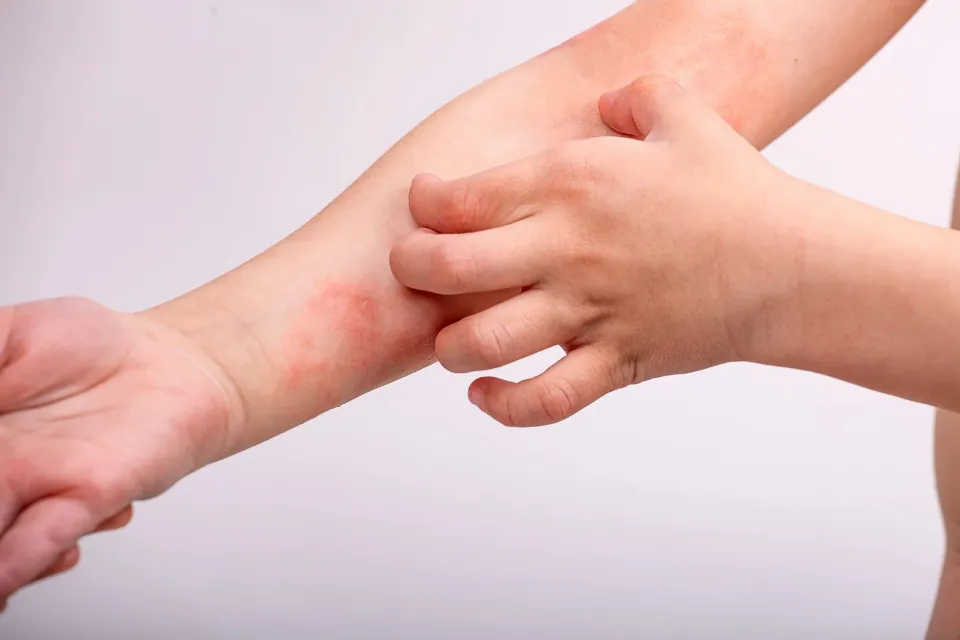 Dermatitis en los meses cálidos Dermatitis en los meses cálidos: el polen, el sudor y el calor afectan la piel sensible