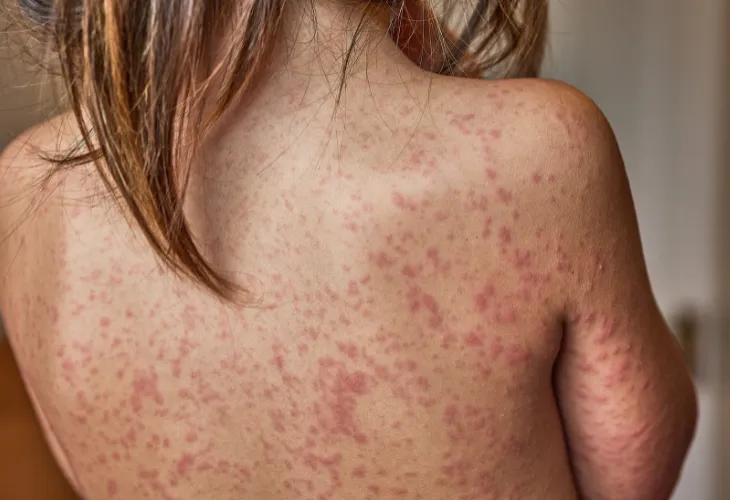 Fotodermatitis Fotodermatitis