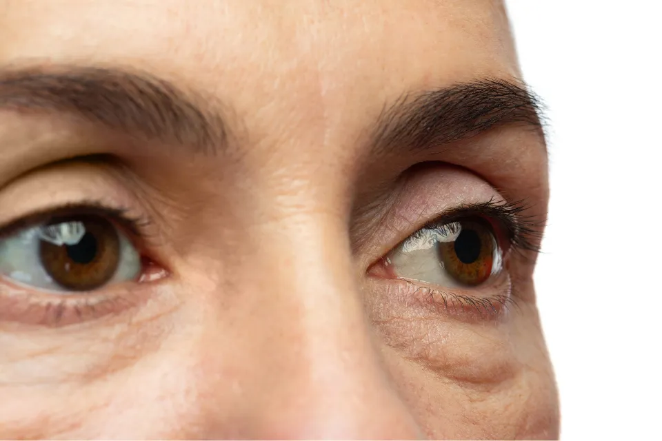 Bolsas de ojos 